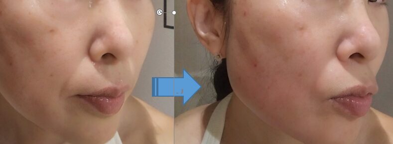 フェイシャルエステ前後の右ほほ