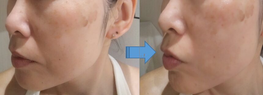 フェイシャルエステ前後の左ほほ